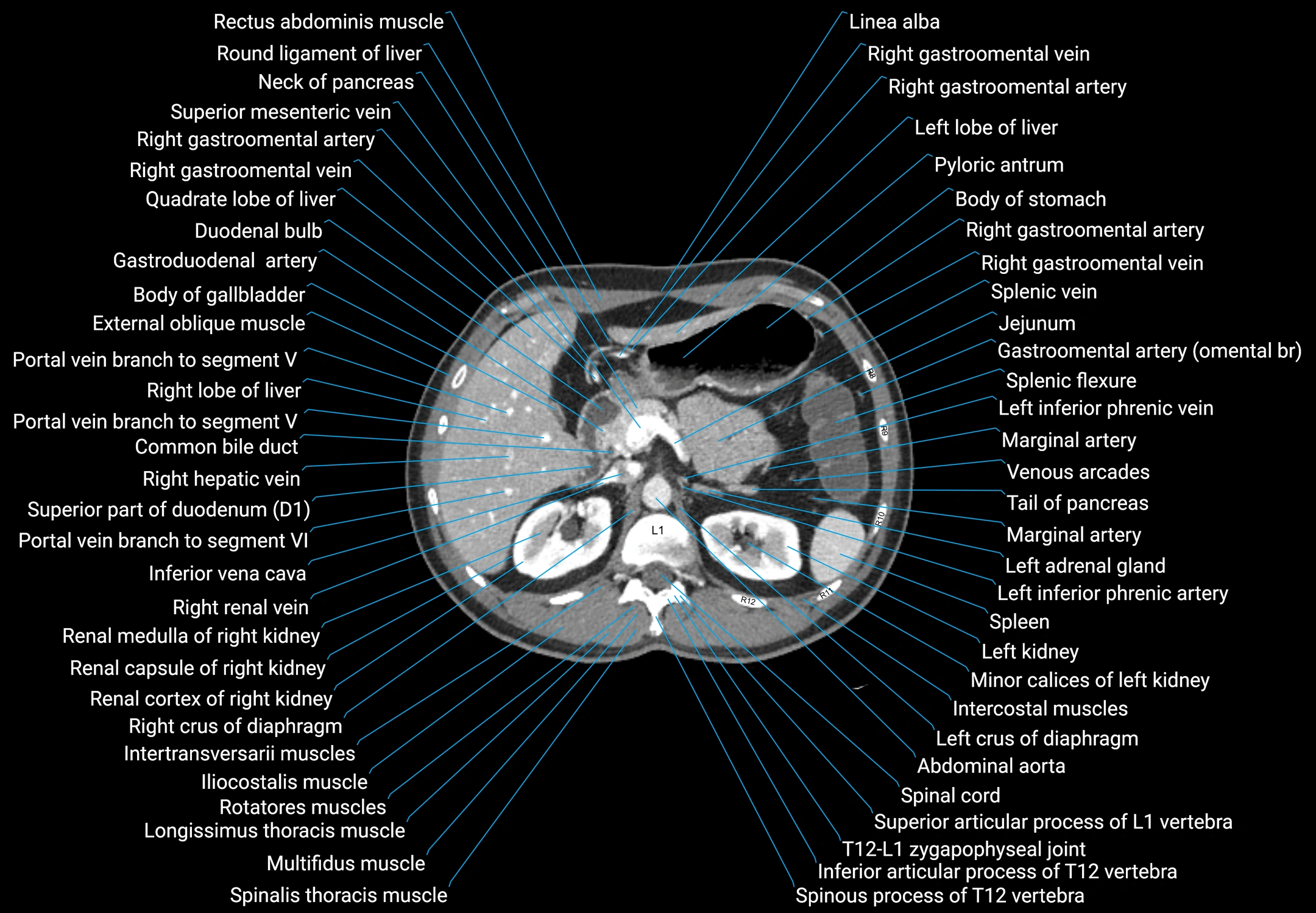 CT male pelvis axial cross sectional anatomy labelled radiology image -00051.webp